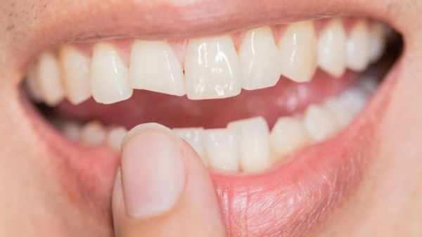 Faktor dan Jenis Penyebab Gigi Retak